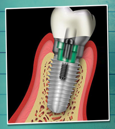 Componentes y osteointegración implante dental 